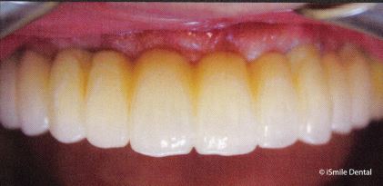 Full Arch Restoration Patient After