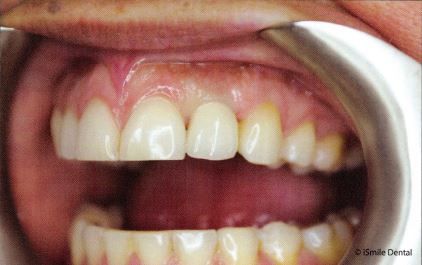 Implant Supported Single Crown
