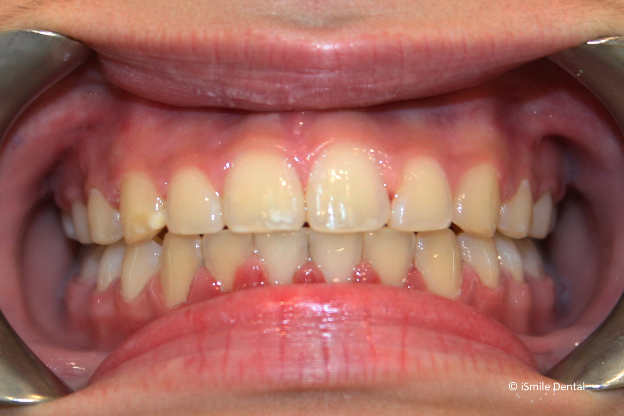 Adolescent Orthodontic Case After