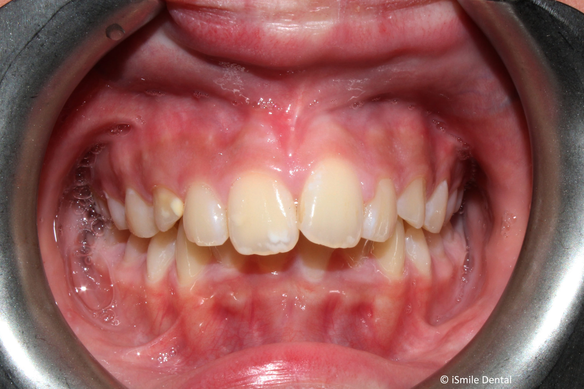 Adolescent Orthodontic Case Before