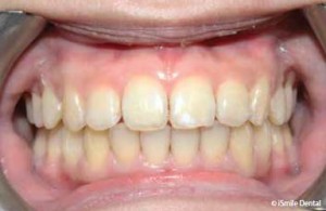 Adolescent Orthodontic Case After