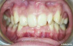 Adoescent Orthodontic Case Before