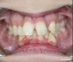 Adult Orthodontic Case Before