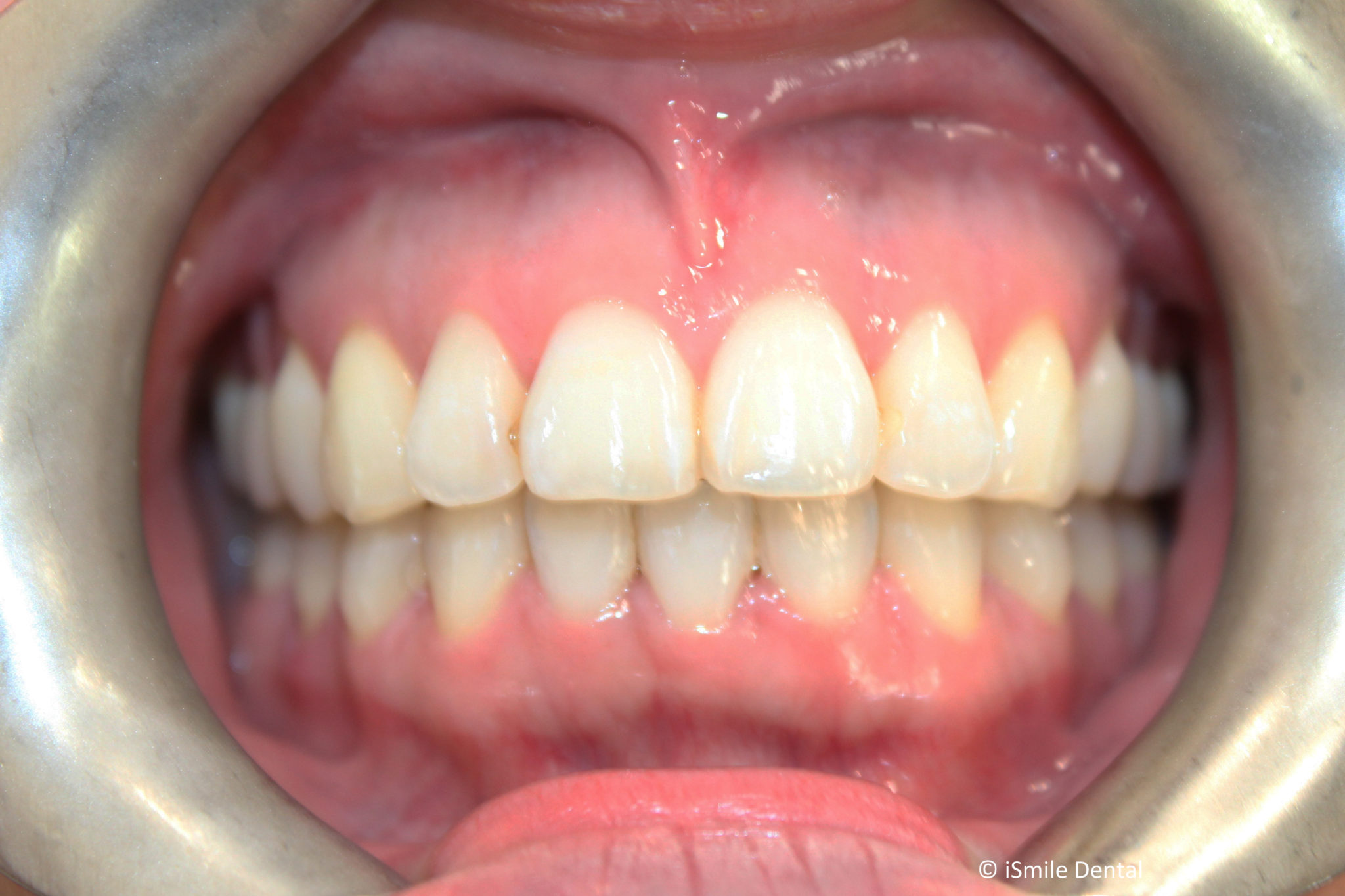 Adult Orthodontic Case After