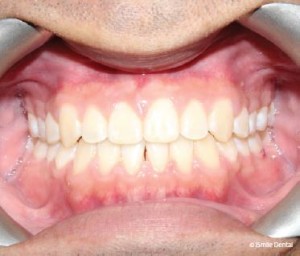 Adult Orthodontic Case After