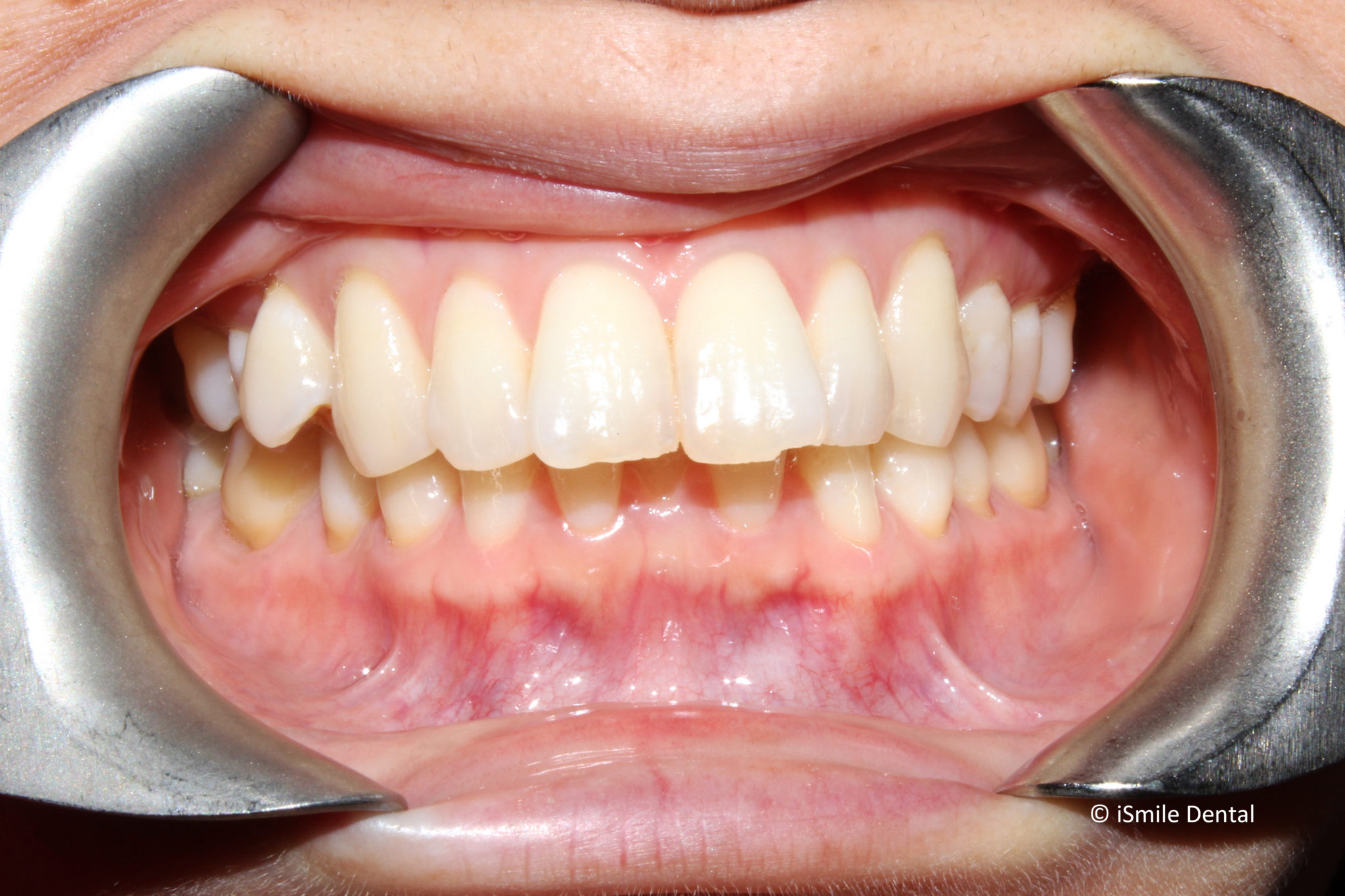 Adult Orthodontic Case Before