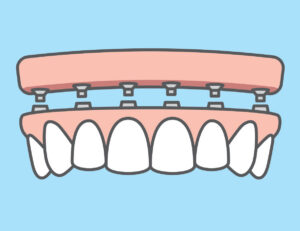 All-on-6 dental implant