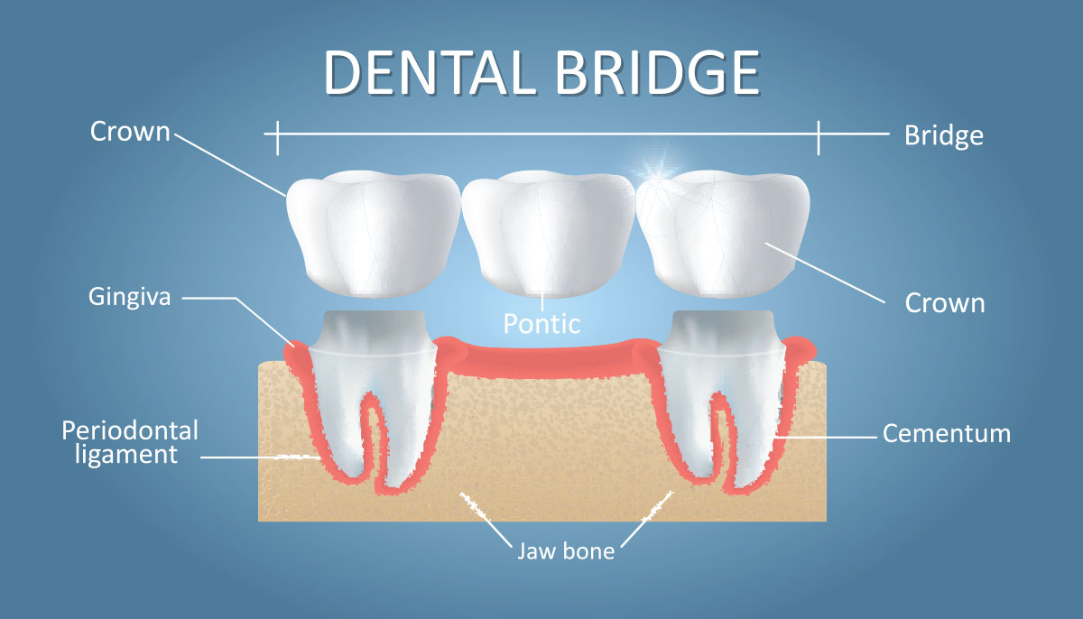 Bridges iSmile Dental