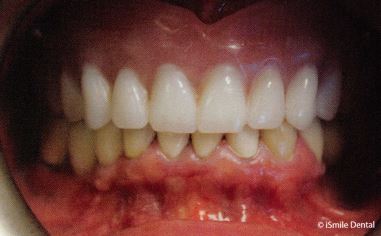 An example of an implant overdenture.