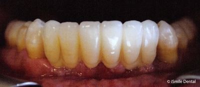 Example of lower, double implant supported bridge.
