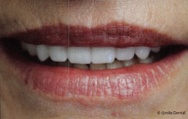 The smile of an overdenture denture patient.