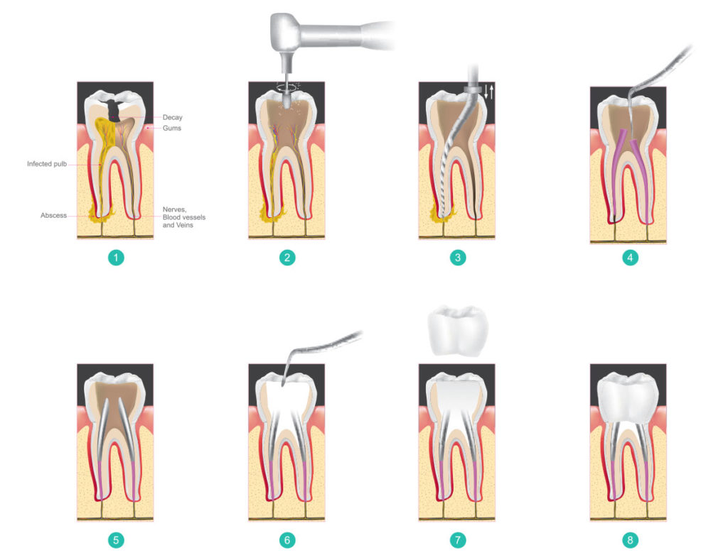 Root Canal Therapy iSmile Dental