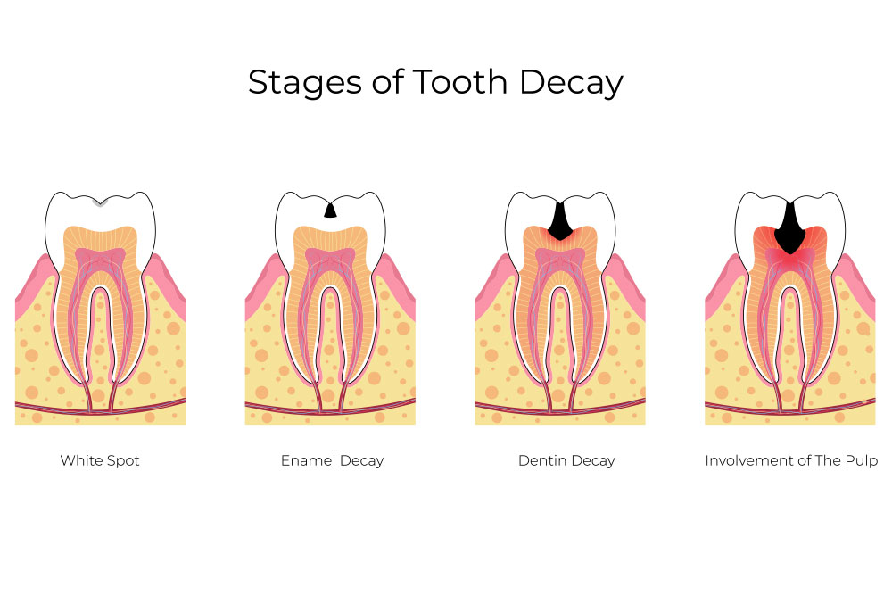 Stages of Tooth Decay