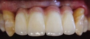 An example of an upper, double implant supported bridge.