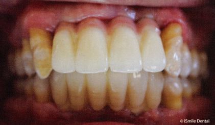 An example of upper and lower implant supported bridges.
